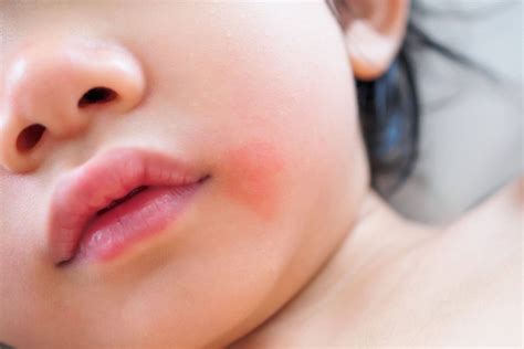 Taches Rouges Sur La Peau Causes Symptômes Et Traitement
