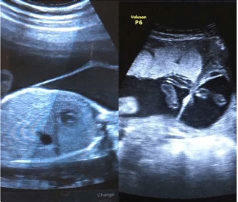 A The First Image Is Amniotic Band And 1b Second Image Is