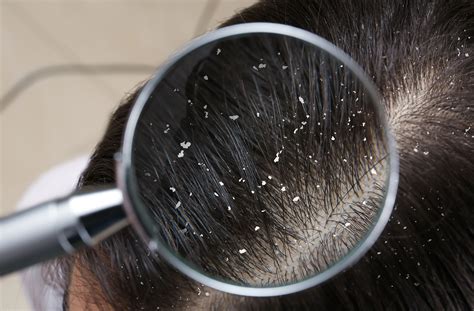 Can Dandruff Cause Hair Loss Hair Doctors Sydney