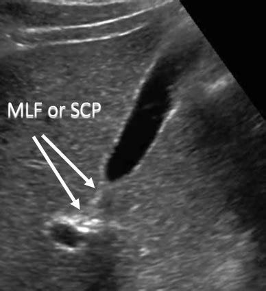 Gallbladder Ultrasound: Normal Anatomy