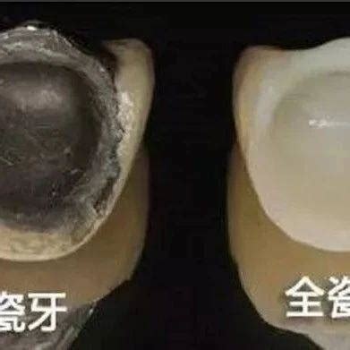 烤瓷牙与全瓷牙应怎样选 金属