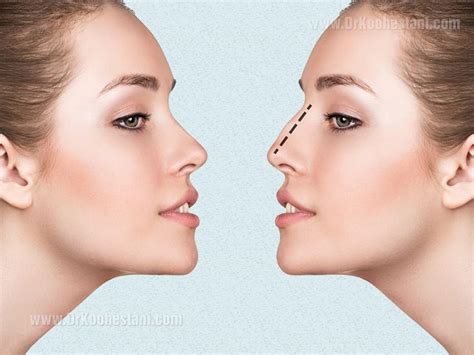 What is Cosmetic Nose Surgery? - Dr. Koohestani