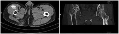 Plain Pelvic Computed Tomography Scan And Three Dimensional