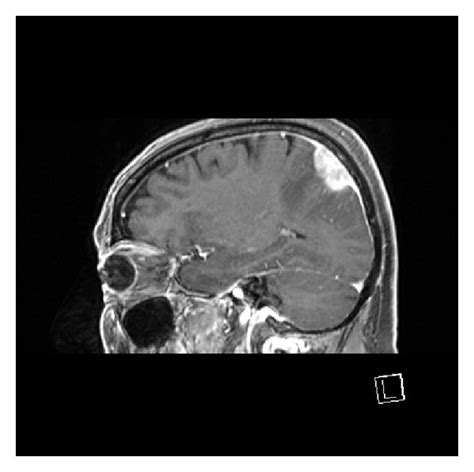 Gd Enhanced T Weighted Mri Axial A Sagittal B And Coronal C