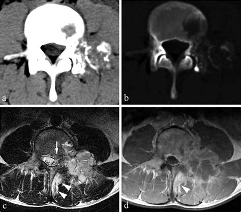 Osteoblastoma In A 29 Year Old Male Enneking Stage 2 On Ct And Stage 3