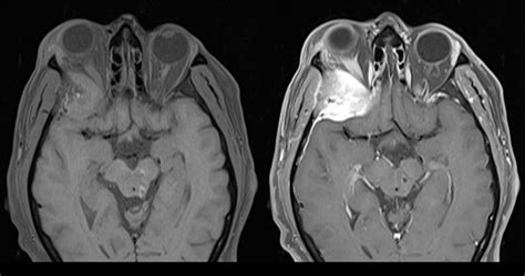 Ultimate Radiology : Meningioma / hemangiopericytoma presenting as proptosis