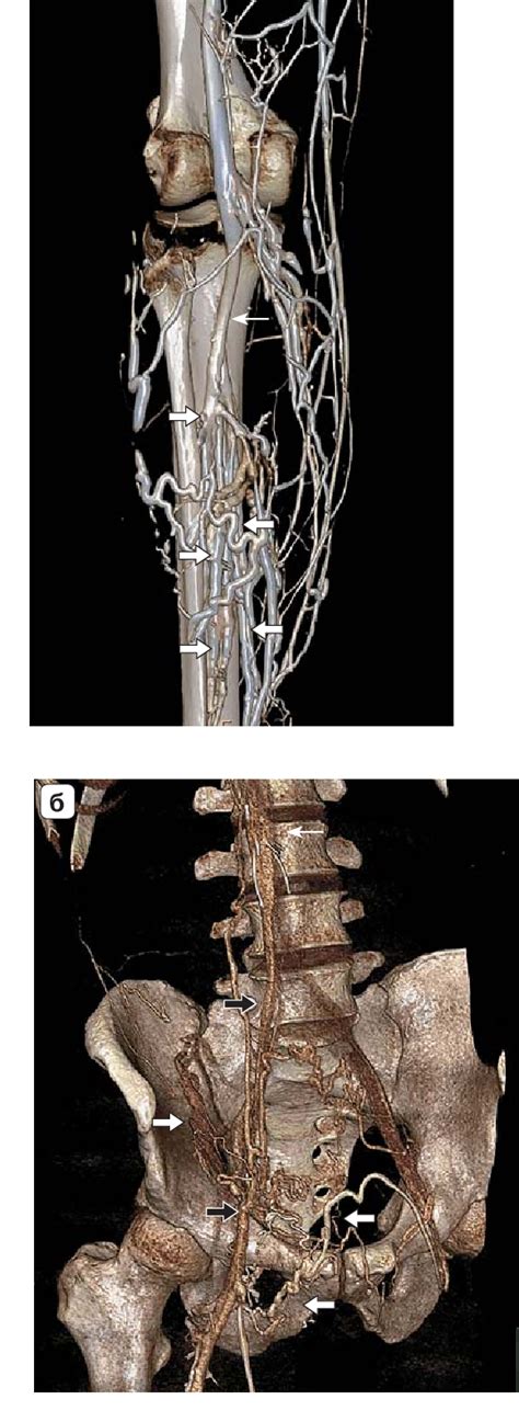 Figure From Mri And Ct Venography In The Diagnosis Of Hemodynamic