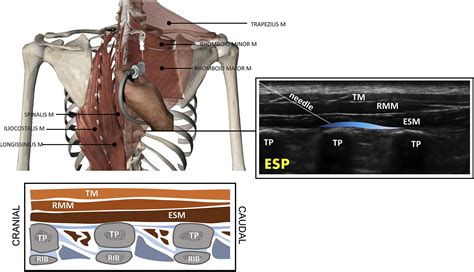 Ultrasound Guided Fascial Plane Blocks Of The Thorax Advances In