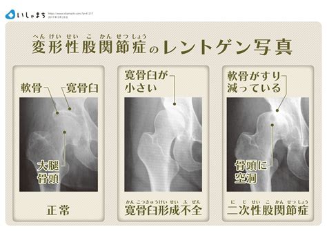 変形性股関節症のレントゲン写真解説 Infographics Rehabilitation Visualisation Job