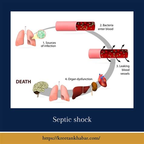 Understanding Septic Shock Causes Symptoms Diagnosis And Treatment