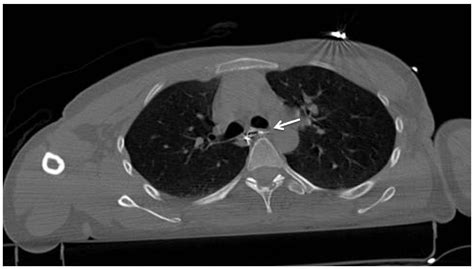 Blunt Trauma Patient With Esophageal Perforation The Western Journal