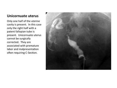 Commonly Seen Uterine Abnormalities On Hysterosalpingography Hsg