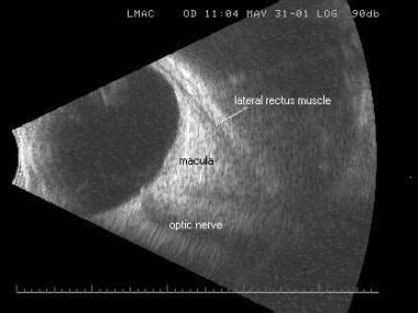 B Scan Ocular Ultrasound Overview Indications For Examination