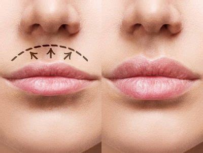 Plasma Fibroblast Lip Augmentation Flip Lift Contour For Fuller Pouty Lips