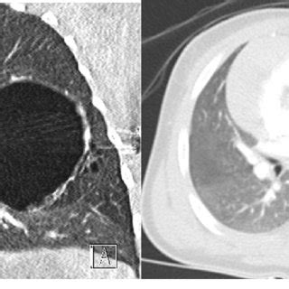 Pathology Diagnosis Congenital Lobar Emphysema Radiological Diagnosis