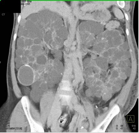 Polycystic Kidney Disease X Ray