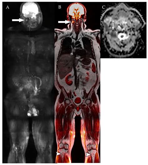 Advanced Imaging in Multiple Myeloma: New Frontiers for MRI
