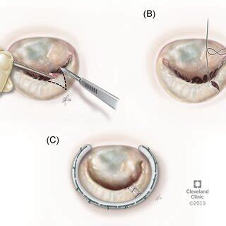 Mitral Valve Repair By A Triangular Resection Technique A Triangular