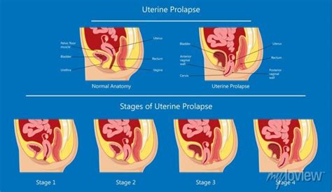 Uterine Prolapse Uterus Vagina Pelvic Floor Muscles Bladder Patient Posters For The Wall