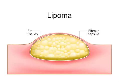 Best Lipoma Treatment in Delhi | Dr Kapil Agrawal