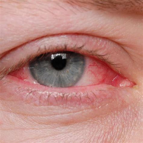 The Comprehensive Guide To Pink Eye Conjunctivitis Symptoms Signs