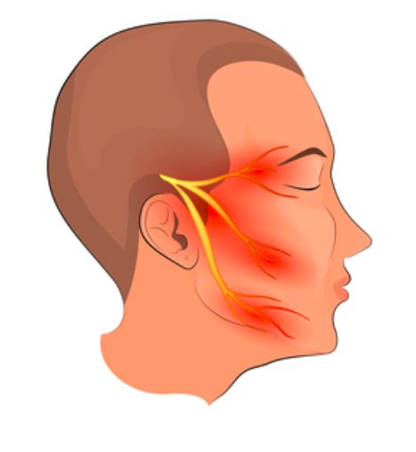 Trigeminus Neuralgie Ziekte Info Neurologen Alrijne