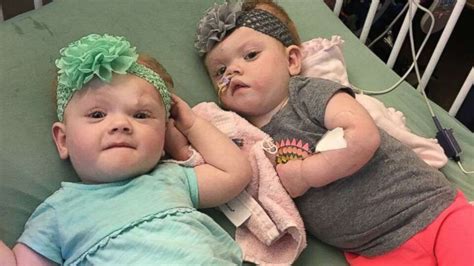 Formerly Conjoined Twins Recovering After Terrifying Separation Good Morning America