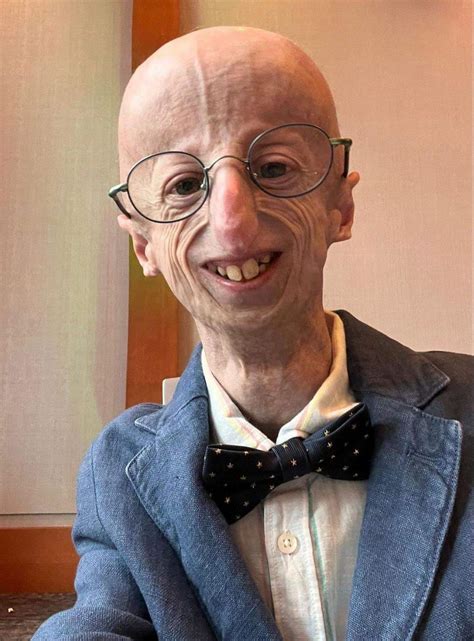 Muere Sammy Basso, el científico italiano que visibilizó la progeria, a