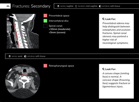 Differential Diagnosis of Infographic: CT Cervical Spine Interpretation