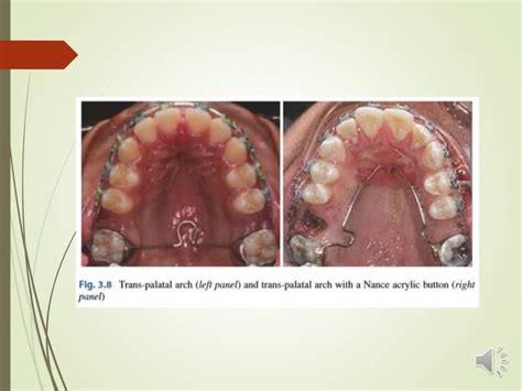 Orthodontics Problems First Permanent Molars Formation Eruption And Extraction