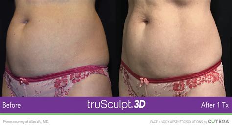 Trusculpt® 3d Fat Reduction Body Contouring Winnipeg The De