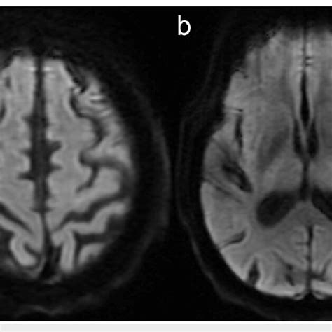 Mri Brain Without Contrast Dwi Axial View Download Scientific Diagram