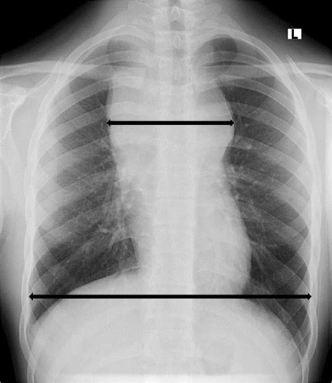 Large mediastinal adenopathy, which is one factor relating to poorer ...