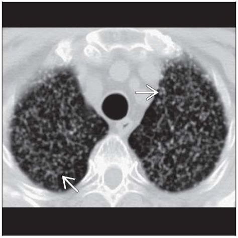 Tuberculosis Miliary Radiology Key