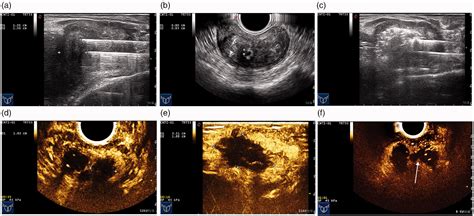 Figure 1 From Ultrasound Guided Transperineal Laser Ablation For