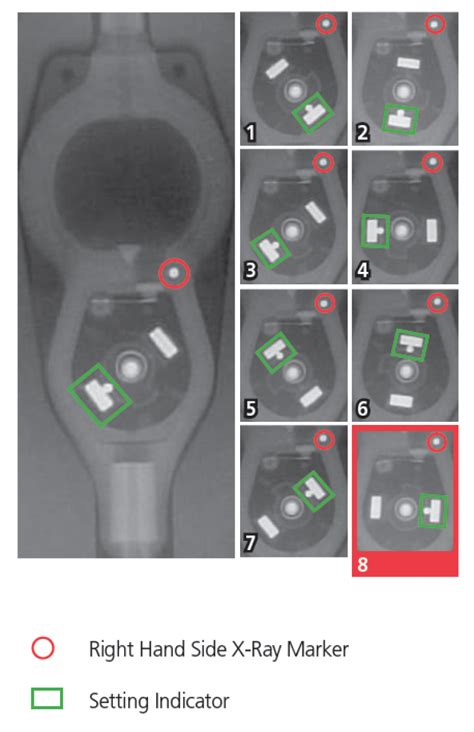 Determining Settings Of Programmable Vp Shunts Uw Emergency Radiology