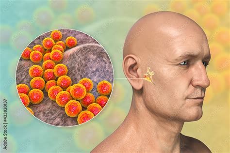 Staphylococcus Aureus Bacterium As A Cause Of Otitis Media Stock