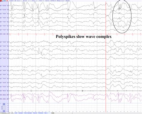 Polyspikes Slow Wave Complex Eegpedia