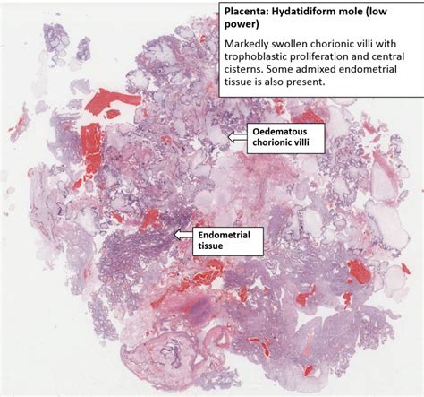 Uterus And Placenta Hydatidiform Mole Nus Pathweb Nus Pathweb