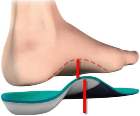 Plantar Fasciitis Treatment In Sydney Orthotic Solutions Podiatry