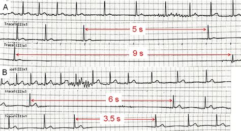 Figure1.ECG monitoring findings demonstrating asystole with syncope and ...