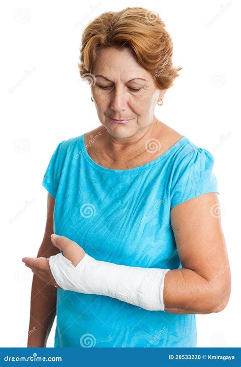 Femme Avec Un Bras Cassé Sur Un Moulage De Plâtre Photo stock Image