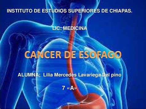 Cancer De Esofago