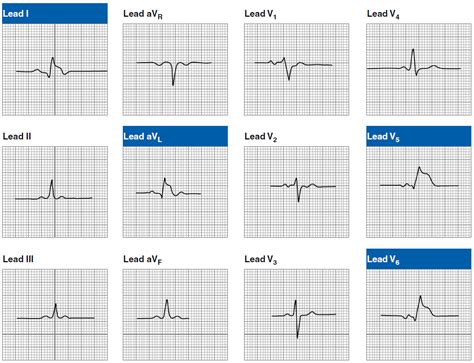 Ekg Acute Myocardial Infarction Patterns Brilliant Nurse® Myocardial Infarction Ekg Nurse