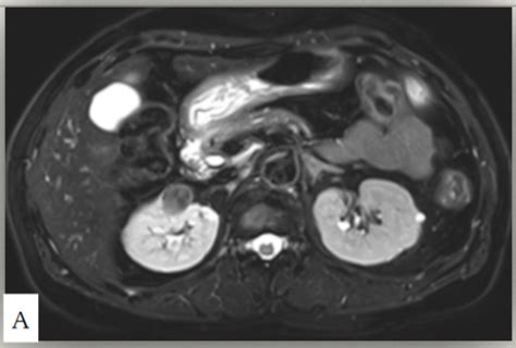 Mri Abdomen Pulse Sequences Flashcards Quizlet