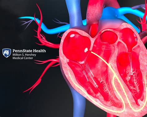 Minimally Invasive Treatments For Structural Heart Disease By Penn