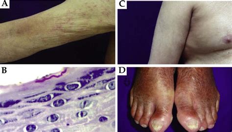 A Ill Defined Erythematous Scaly Papules And Plaques On Upper Limbs