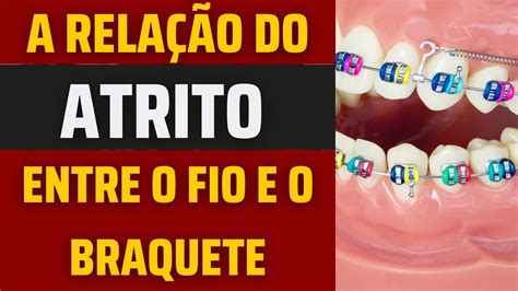 A Rela O Do Atrito Fric O Entre O Fio Ortod Ntico E O Braquete No