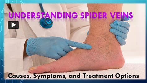 Ppt Understanding Spider Veins Causes Symptoms And Treatment Options Powerpoint Presentation