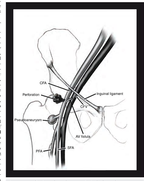 Cardiac Catheterization Femoral Artery